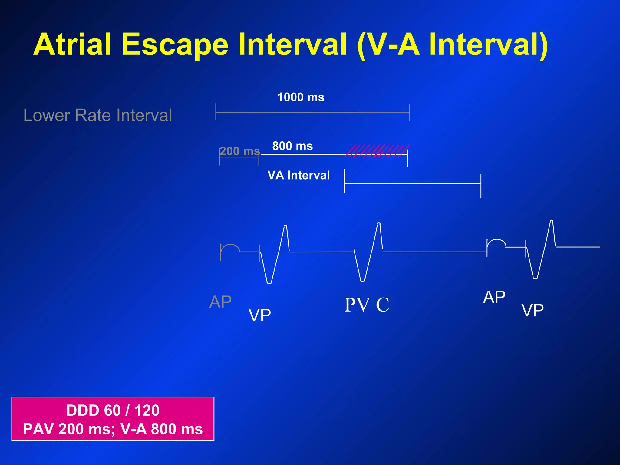 Lower Rate Interval
AP
VP
AP
VP
VA Interval
Atrial Escape Interval (V-A Interval)
DDD 60 / 120
PAV 200 ms; V-A 800 ms
200 ms 800 ms
1000 ms
PV C
 