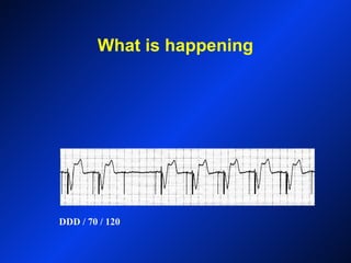 What is happening
DDD / 70 / 120
 