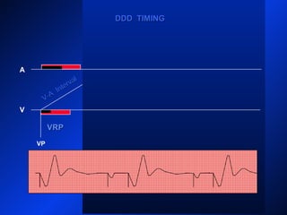 VP
A
V
PVARPPVARP
AP
VP
DDD TIMINGDDD TIMING
V-A
Interval
V-A
Interval
VRPVRP
 