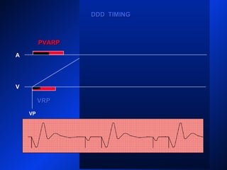 VP
A
V
PVARPPVARP
AP
VP
DDD TIMINGDDD TIMING
VRPVRP
PVARPPVARP
 