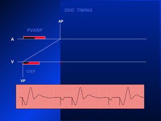 VP
A
V
PVARPPVARP
VP VP
AP
DDD TIMINGDDD TIMING
VRPVRP
PVARPPVARP
 