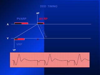 VP
AP
A
V
PVARPPVARP
VP
DDD TIMINGDDD TIMING
VRPVRP
PVARPPVARP AV RP
A-V
Interval
A-V
Interval
 