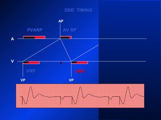 VP VP
AP
A
V
DDD TIMINGDDD TIMING
PVARPPVARP
VRPVRP
VP
AV RPAV RPPVARPPVARP
VRPVRP
 