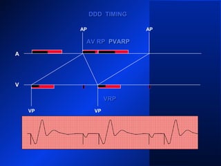 VP VP
AP
A
V
DDD TIMINGDDD TIMING
PVARPPVARPAV RPAV RP PVARPPVARP
VRPVRP
VP
AP
 