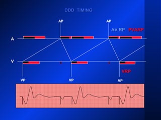 VP VP
AP AP
A
V
DDD TIMINGDDD TIMING
AV RPAV RP PVARPPVARP
VRPVRP
VP
 