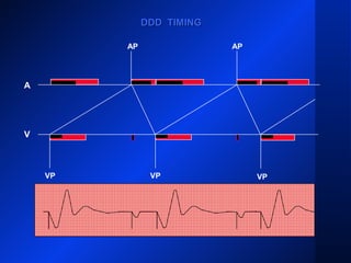 VP VP
AP AP
A
V
DDD TIMINGDDD TIMING
VP
 