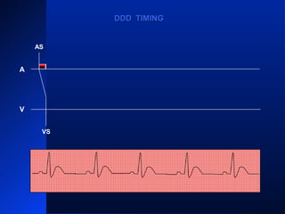 AS AS ASAS
VS VS VSVS
AS
A
V
DDD TIMINGDDD TIMING
VS
 