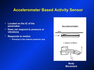 Accelerometer Based Activity Sensor
• Located on the IC of the
pacemaker
• Does not respond to pressure or
vibrations
• Responds to motion
– Primarily in the anterior-posterior axis
Body
Movement
 