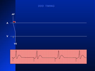 VS VS
AP AP AP
VS
AP
A
V
DDD TIMINGDDD TIMING
VS
 