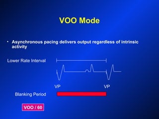 VOO Mode
Blanking Period
VP VP
Lower Rate Interval
VOO / 60
• Asynchronous pacing delivers output regardless of intrinsic
activity
 