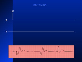 A
V
VS
PVARPPVARP
VRPVRP
ARP PVARPPVARP ARP PVARPPVARP
ARP
AS
VP
PVARPPVARP
AS
VP
ARPARPPVARPPVARPAV RPAV RP
AP
DDI TIMINGDDI TIMING
 