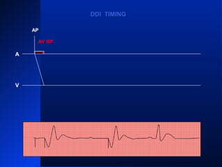 AP
A
V
VS
PVARPPVARP
VRPVRP
ARP PVARPPVARP ARP PVARPPVARP
ARP
AS
VP
PVARPPVARP
AS
VP
ARPARPPVARPPVARP
DDI TIMINGDDI TIMING
AV RPAV RP
 