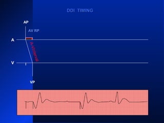 AP
A
V
VS
PVARPPVARP
VRPVRP
ARP PVARPPVARP ARP PVARPPVARP
ARP
AS
VP
PVARPPVARP
AS
ARPARPPVARPPVARP
VP
DDI TIMINGDDI TIMING
A-VInterval
AV RPAV RP
 