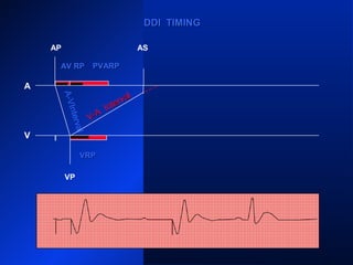 AP
A
V
VP VS
VRPVRP
ARP PVARPPVARP ARP PVARPPVARP
ARP
AS
VP
PVARPPVARPARPARP
AS
DDI TIMINGDDI TIMING
AV RPAV RP PVARPPVARP
A-VInterval
V-A
Interval
V-A
Interval
 