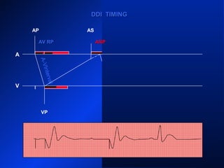 AP
A
V
AS
VP VS
PVARPPVARP ARP PVARPPVARP
ARP
AS
VP
PVARPPVARP
DDI TIMINGDDI TIMING
ARPARPAV RPAV RP
A-VInterval
 