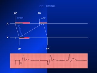 AP
A
V
AS
VP VS
PVARPPVARP ARP PVARPPVARP
ARP
AS
PVARPPVARP
DDI TIMINGDDI TIMING
VP
ARPARPAV RPAV RP
A-VInterval
 