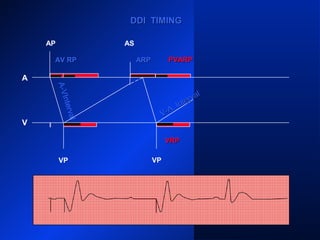 DDI TIMINGDDI TIMING
AP
A
V
AS AS
VP VP
ARPARP
A-VInterval
AV RPAV RP ARP
V-A
Interval
V-A
Interval
PVARPPVARP
VRPVRP
 