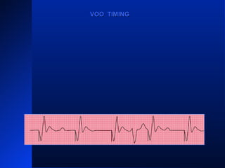 VPVPVP VP
VOO TIMINGVOO TIMING
 