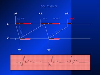 DDI TIMINGDDI TIMING
AP
A
V
AS AS
VP VP
ARPARP
A-VInterval
AV RPAV RP
V-A
Interval
V-A
Interval
PVARPPVARP ARP
 