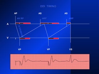 DDI TIMINGDDI TIMING
AP
A
V
AS AS
VP VP VS
ARPARPARP
A-VInterval
AV RPAV RP
 