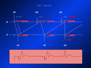 DDI TIMINGDDI TIMING
AP
A
V
AS AS
VP VP VS
VRPVRP
ARPARPARP
A-VInterval
PVARPPVARPAV RPAV RP
 