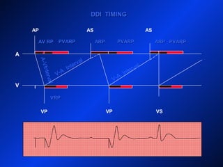 DDI TIMINGDDI TIMING
AP
A
V
AS AS
VP VP VS
ARPARPARPARPAV RPAV RP
A-VInterval
PVARPPVARPPVARPPVARP
V-A
Interval
PVARPPVARP
V-A
Interval
VRPVRP
 