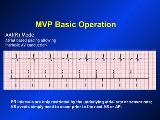 MVP Basic Operation
AAI(R) Mode
Atrial based pacing allowing
intrinsic AV conduction
PR Intervals are only restricted by the underlying atrial rate or sensor rate;
VS events simply need to occur prior to the next AS or AP.
 