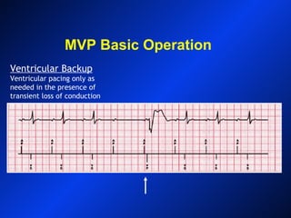 MVP Basic Operation
Ventricular Backup
Ventricular pacing only as
needed in the presence of
transient loss of conduction
 