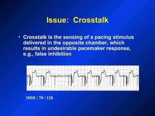 Issue: Crosstalk
• Crosstalk is the sensing of a pacing stimulus
delivered in the opposite chamber, which
results in undesirable pacemaker response,
e.g., false inhibition
DDD / 70 / 120
 