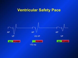 PVARP
Ventricular Safety Pace
AV PVARP PVARP AV
110 ms
VS VPVP VP
AP APAP
 