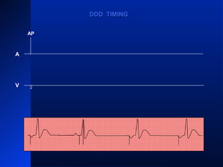 VS VS VS
APAPAPAP
A
V
DDD TIMINGDDD TIMING
 