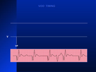 VPVPVP VPVP
VOO TIMINGVOO TIMING
V
 