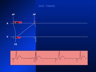 VS VS VS
AP AP APAP
A
V
DDD TIMINGDDD TIMING
 