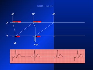DDD TIMINGDDD TIMING
VS VS VS
AP AP AP
VSP
A
V
AP
 