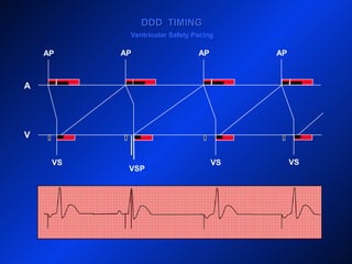 A
V
DDD TIMINGDDD TIMING
VS VS VS
AP AP AP AP
VSP
Ventricular Safety Pacing
 