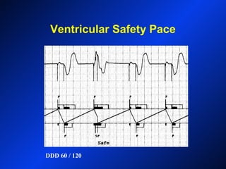 Ventricular Safety Pace
DDD 60 / 120
 