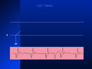 VP VPVPVP VP
VOO TIMINGVOO TIMING
V
 