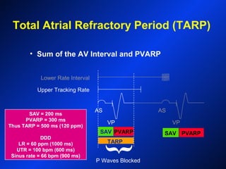 PVARP
Upper Tracking Rate
Lower Rate Interval
{
P Waves Blocked
AS AS
VPVP
SAV = 200 ms
PVARP = 300 ms
Thus TARP = 500 ms (120 ppm)
DDD
LR = 60 ppm (1000 ms)
UTR = 100 bpm (600 ms)
Sinus rate = 66 bpm (900 ms)
SAV
TARP
PVARP
Total Atrial Refractory Period (TARP)
• Sum of the AV Interval and PVARP
SAV
 