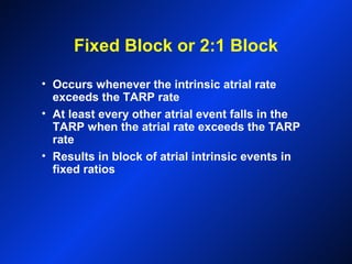 Fixed Block or 2:1 Block
• Occurs whenever the intrinsic atrial rate
exceeds the TARP rate
• At least every other atrial event falls in the
TARP when the atrial rate exceeds the TARP
rate
• Results in block of atrial intrinsic events in
fixed ratios
 