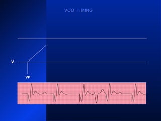 VP VPVPVP VP
VOO TIMINGVOO TIMING
V
 