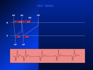 AS
VP VP
AS
VP VP
AS AS
AR ARARAR
VP
A
V
DDD TIMINGDDD TIMING
AS
 