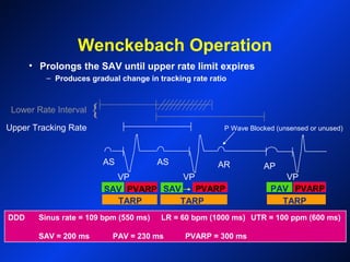 PVARP
Wenckebach Operation
Upper Tracking Rate
Lower Rate Interval {
AS AS AR AP
VPVP VP
TARP
SAV PAV PVARPSAV PVARP
P Wave Blocked (unsensed or unused)
DDD Sinus rate = 109 bpm (550 ms) LR = 60 bpm (1000 ms) UTR = 100 ppm (600 ms)
SAV = 200 ms PAV = 230 ms PVARP = 300 ms
• Prolongs the SAV until upper rate limit expires
– Produces gradual change in tracking rate ratio
TARP TARP
 