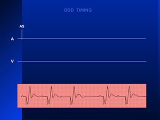ASAS AS
AR
VPVP
AS
VP VPVP
AS
DDD TIMINGDDD TIMING
A
V
AS
 