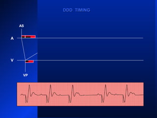 VP
ASAS AS AS
AR
VPVP
AS
VP VP
AS
DDD TIMINGDDD TIMING
A
V
 
