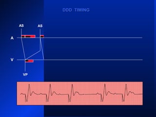 VP
AS ASAS AS AS
AR
VPVPVP VP
AS
A
V
DDD TIMINGDDD TIMING
 