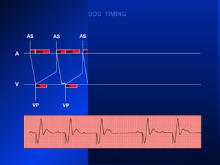 VP VP
AS ASAS AS AS
AR
VPVP VP
A
V
AS
DDD TIMINGDDD TIMING
 