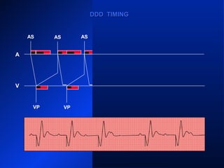 VP
AS
VP
AS ASAS AS AS
AR
VP VPVP
DDD TIMINGDDD TIMING
A
V
 