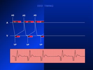 VP
AS
VP VP
AS ASAS AS AS
AR
VPVP
A
V
DDD TIMINGDDD TIMING
 