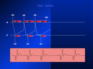 VP
AS
VP VP
AS ASAS AS AS
AR
VPVP
DDD TIMINGDDD TIMING
A
V
 