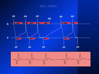 VP
AS
VP VP VP
AS ASAS
DDD TIMINGDDD TIMING
AS AS
AR
A
V
VP
 
